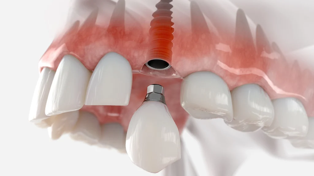 Implantes-de-carga-inmediata-sevilla