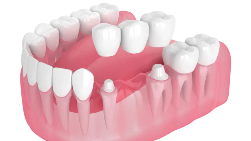 Puente-dental-tradicional