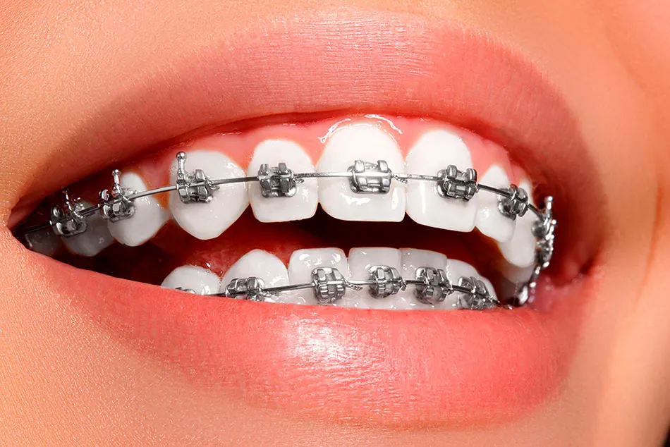 brackets metalicos en sevilla