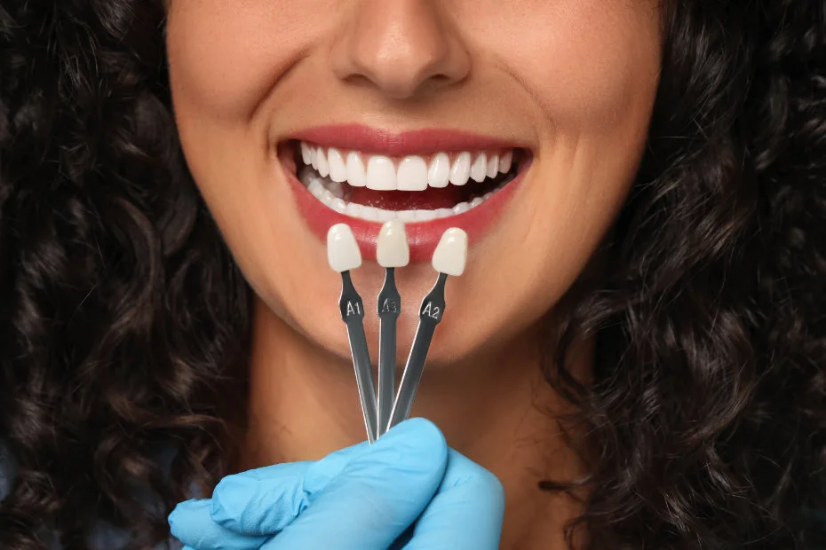 carillas-dentales