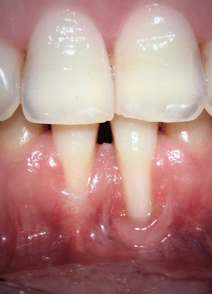 cirugia periodontal antes y despues - antes