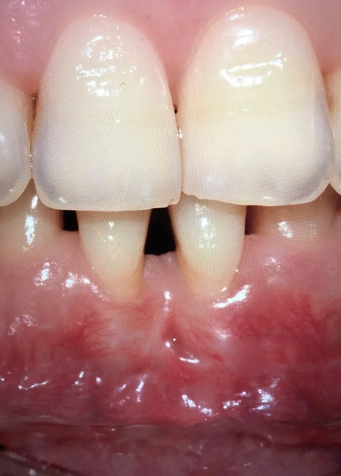 cirugia periodontal antes y despues - despues