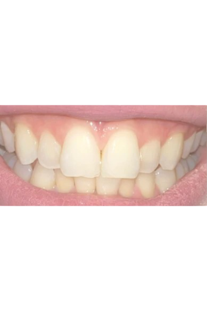 contorneado dental antes y despues -antes
