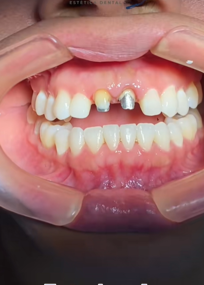 corona dental antes y despues - antes