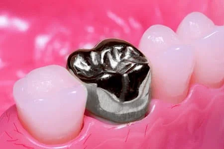 corona-dental-metalica