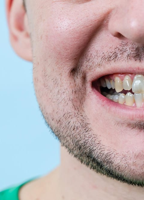curetaje dental antes y despues - antes 2