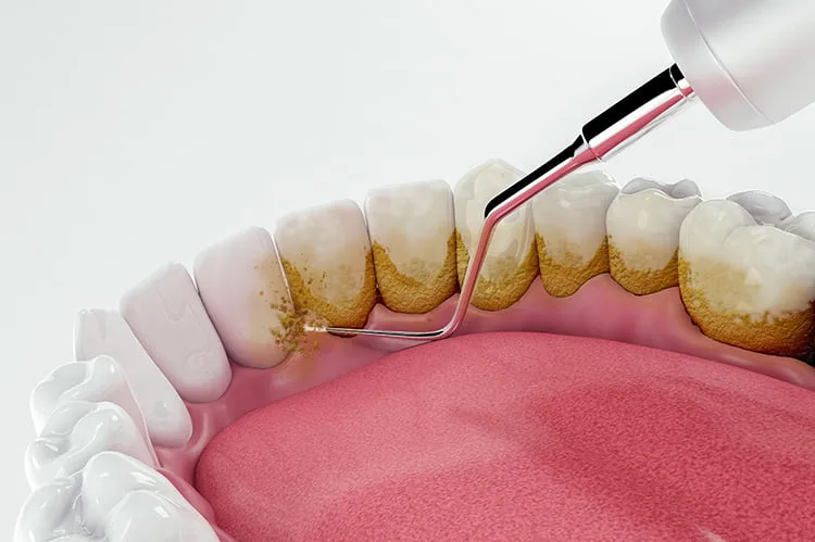 curetaje dental