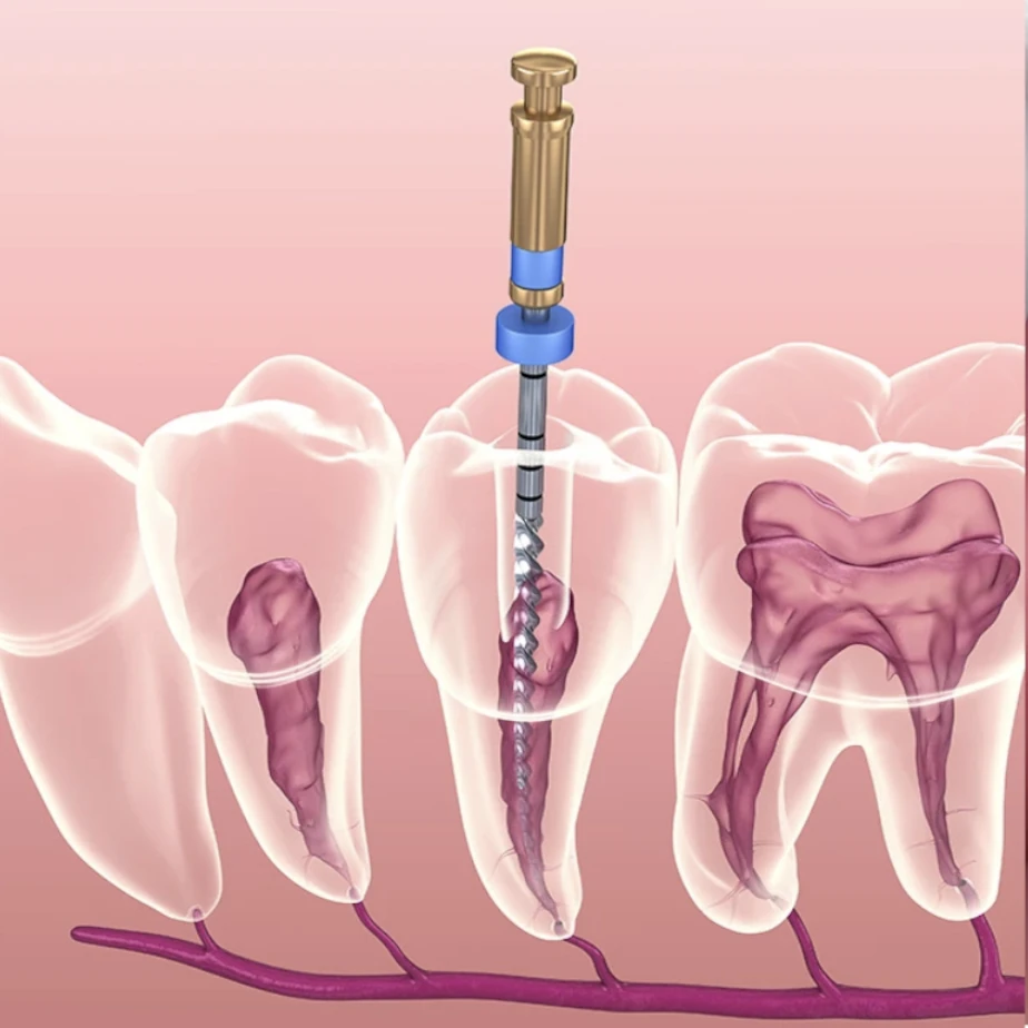 endodoncia