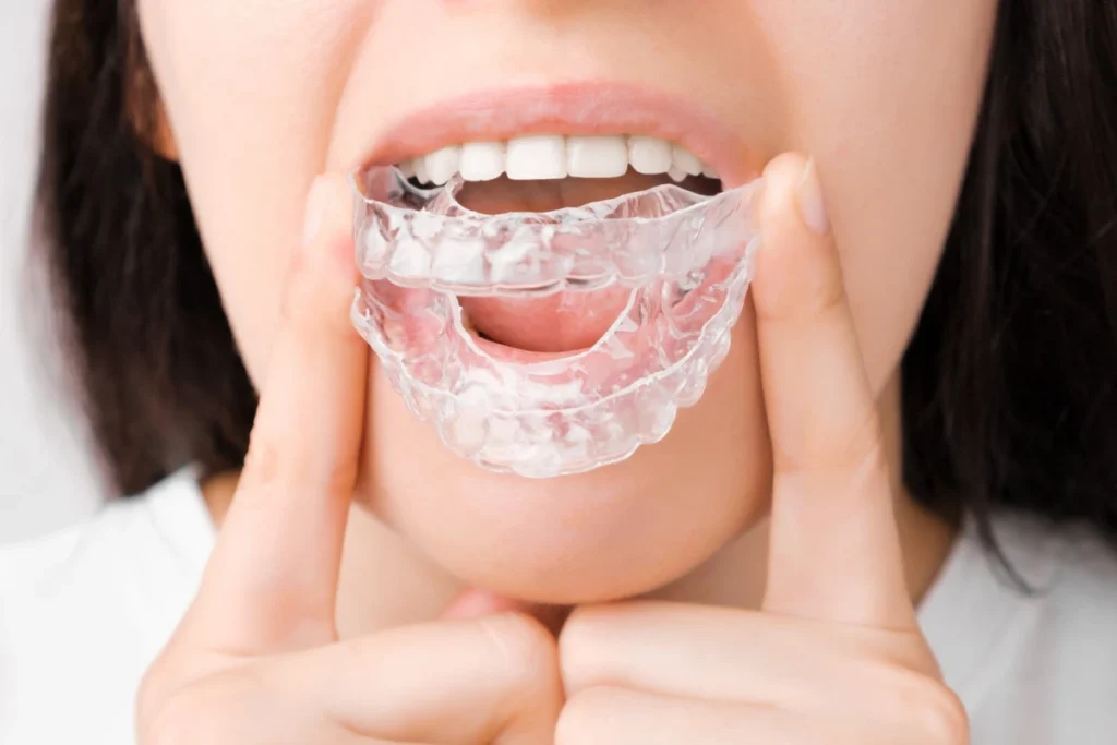 ferulas dentales bruxismo