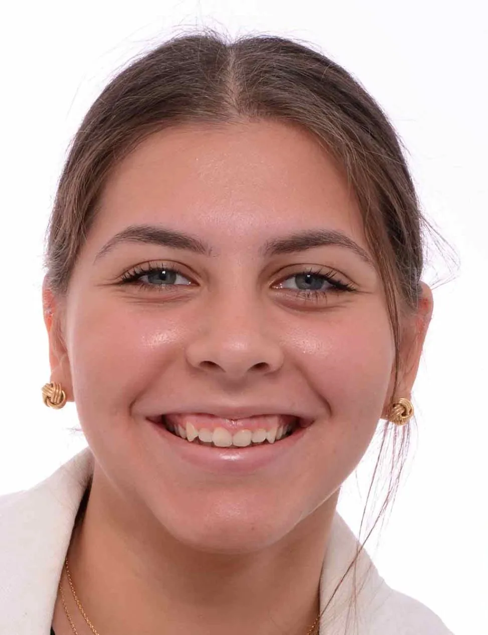 gingivectomia en sevilla antes y despues - antes (1)