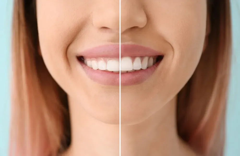 gingivectoplastia