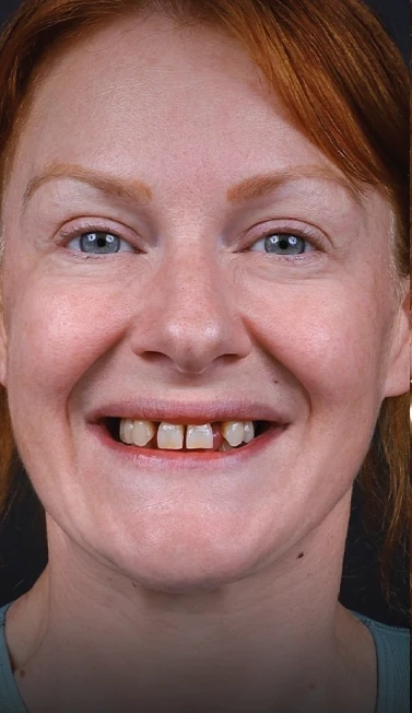 implante dental antes y despues - antes