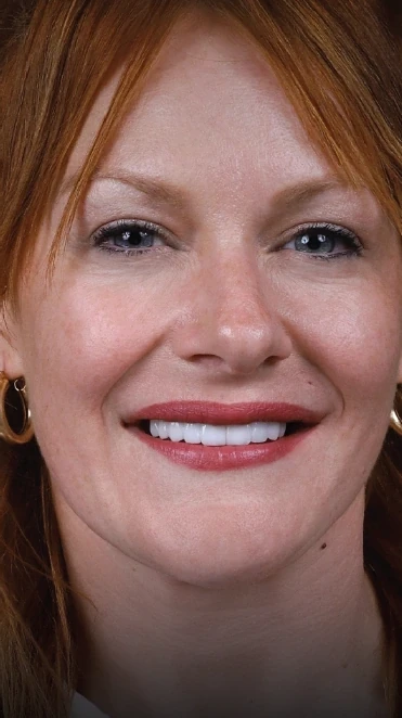 implante dental antes y despues - despues