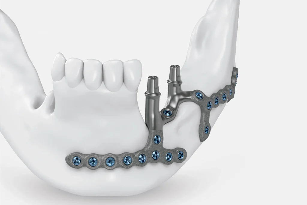 implante-dental-subperiosticos-sevilla