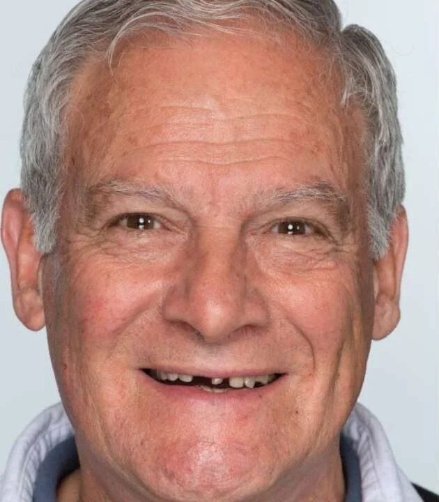 implantes carga inmediata antes y despues - antes
