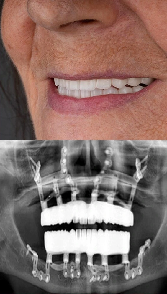 implantes subperiosticos antes y despues - despues