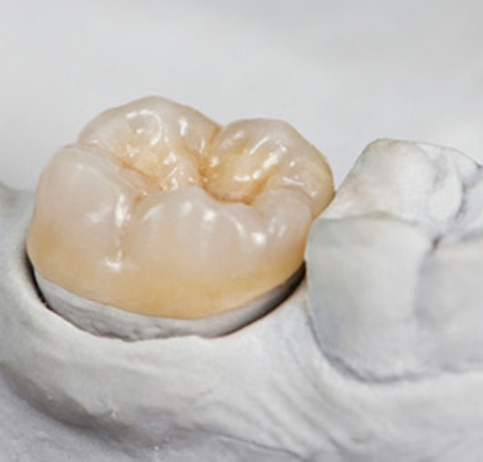 incrustacion dental overlay