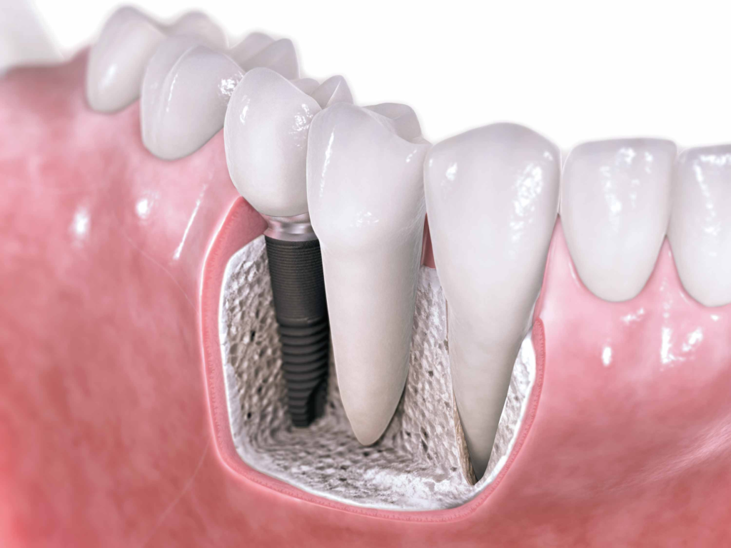 pri-implantes-pacientes-si-hueso