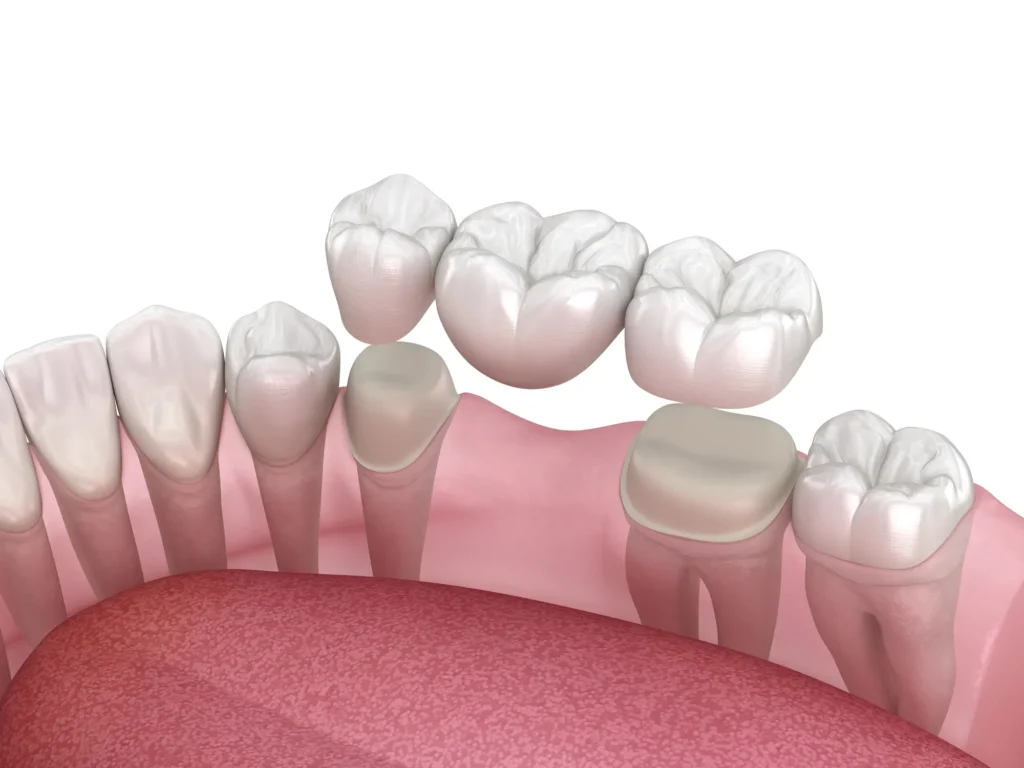 puente-dental