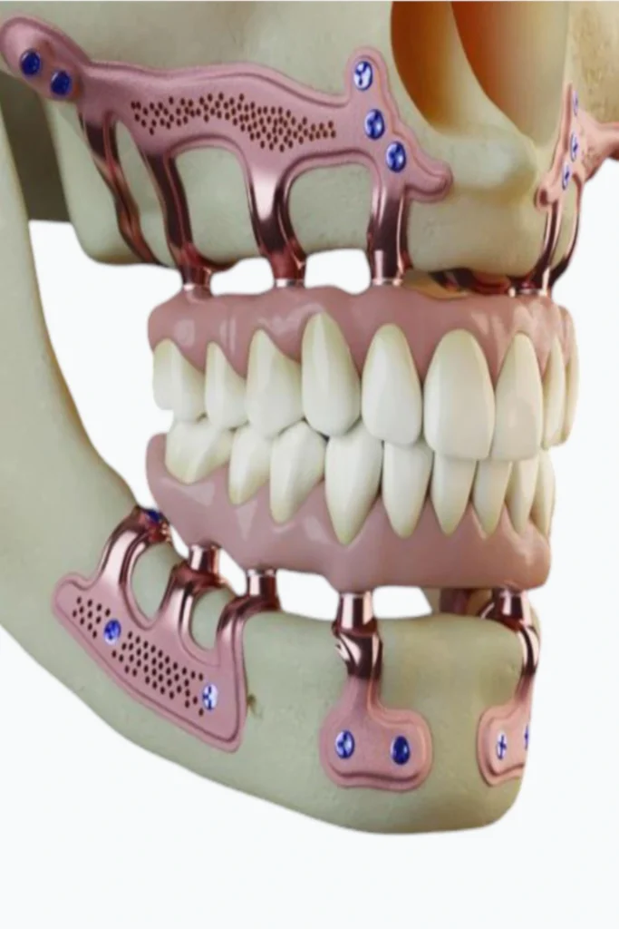 tarjeta-Implantes-subperiosticos