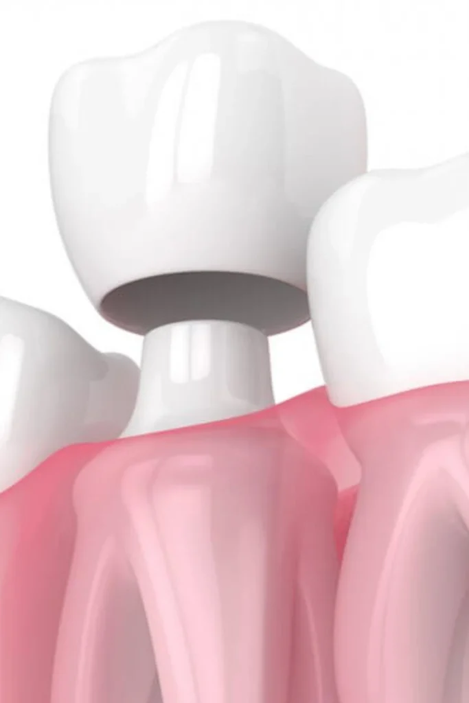 tarjeta corona dental