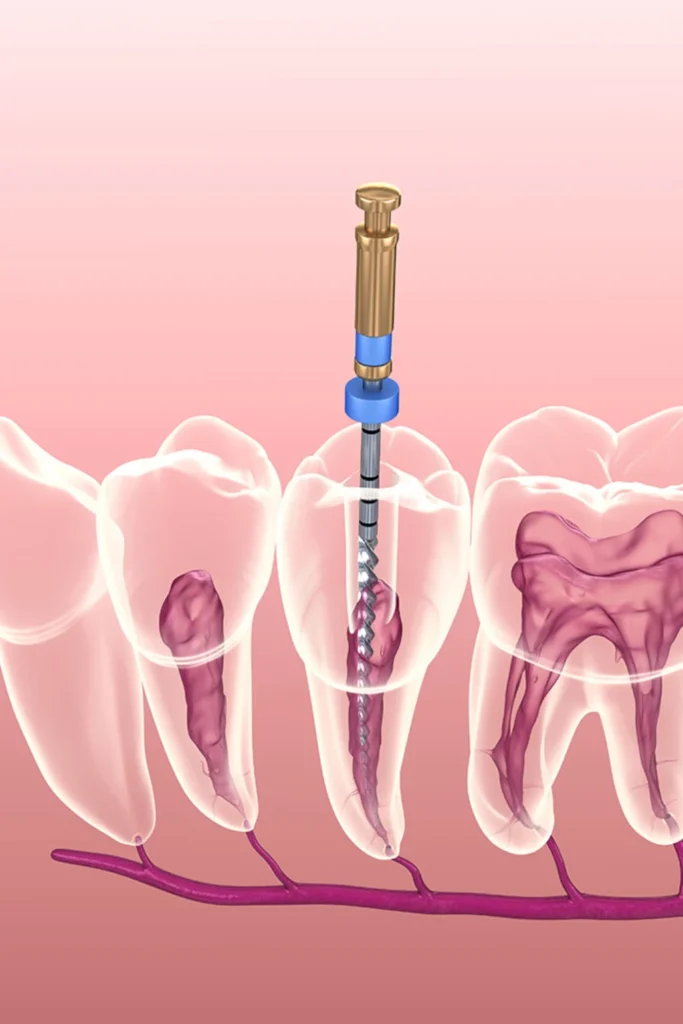 tarjeta endodoncia