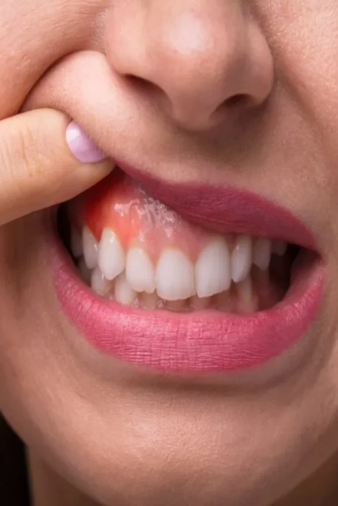 tarjeta-gingivectomia
