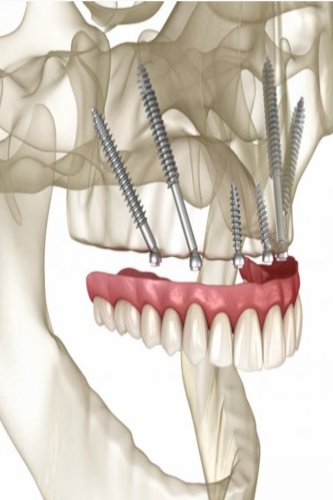 tarjeta-implantes-cigomaticos-en-sevilla