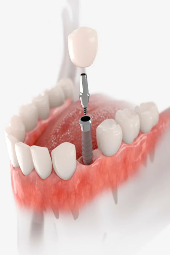 tarjeta - implantes-de-carga-inmediata