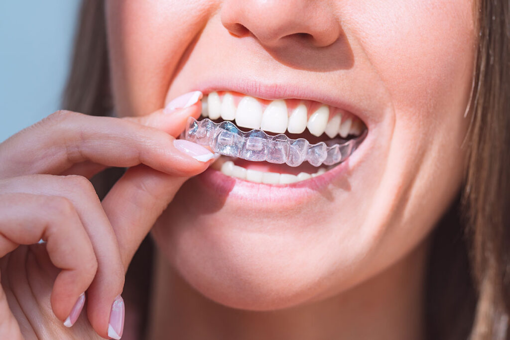 tarjeta-invisalign
