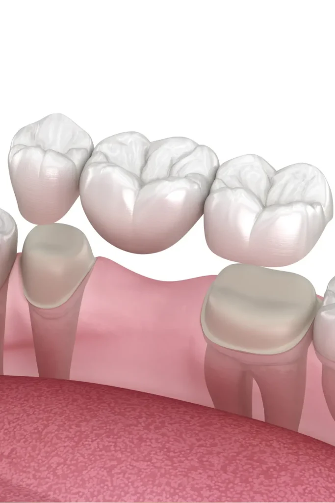 tarjeta-puente-dental